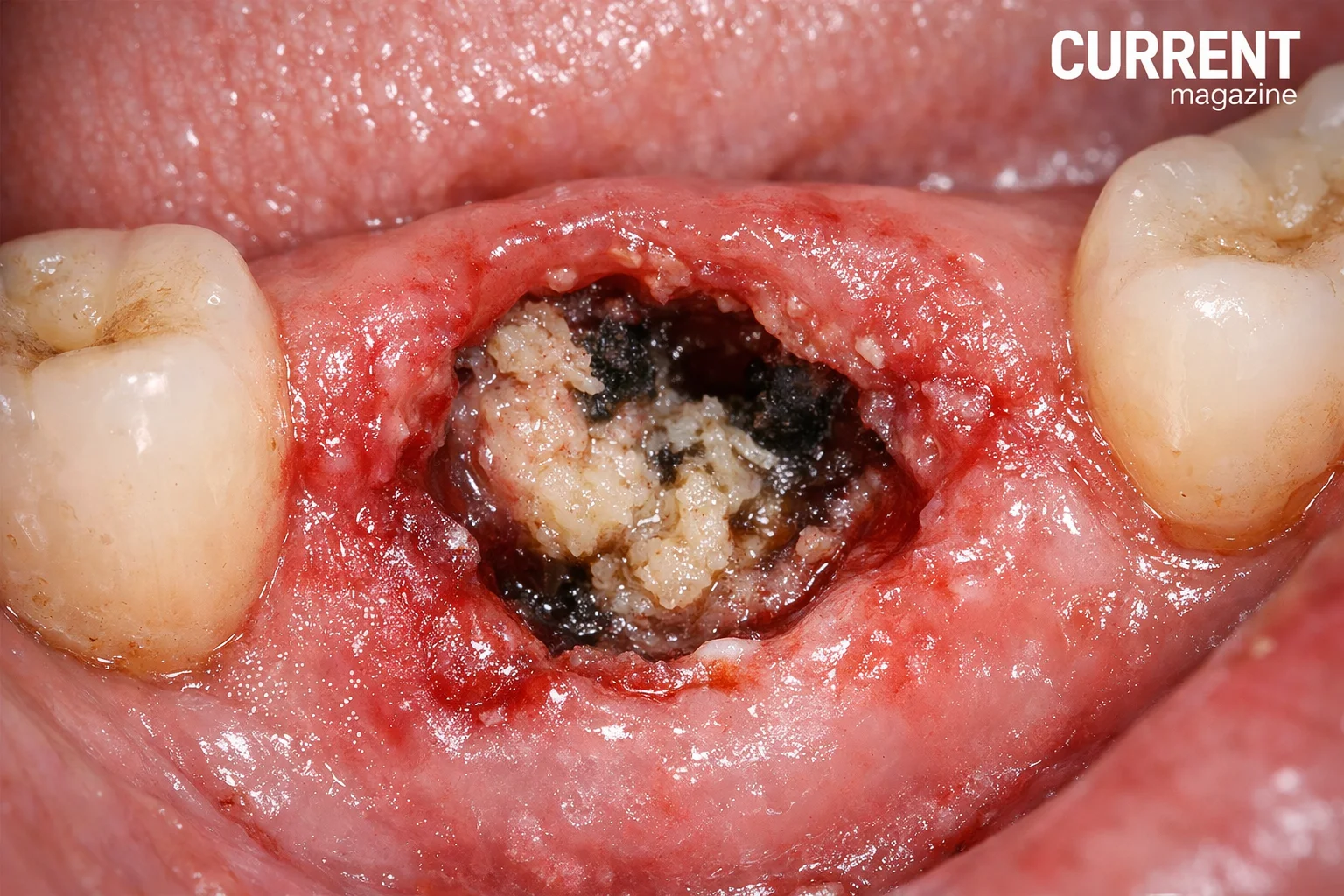 what does dry socket look like