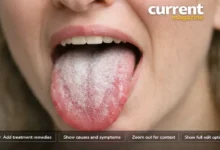 How to Get Rid of White Tongue