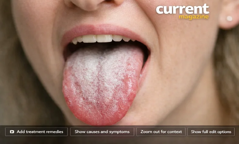 How to Get Rid of White Tongue