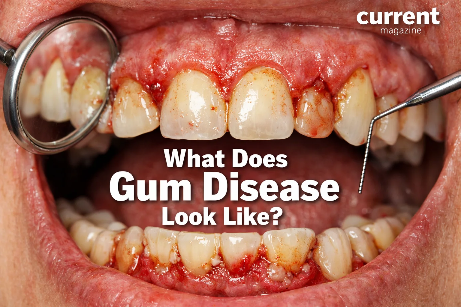 What Does Gum Disease Look Like